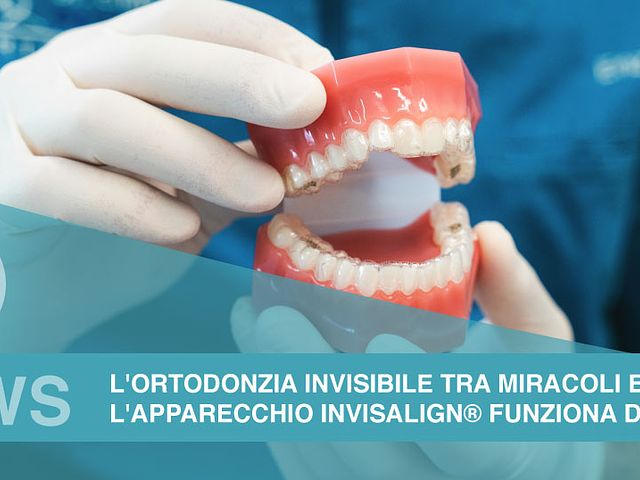 L’apparecchio Invisalign® funziona davvero? L’ortodonzia invisibile tra miracoli e realtà
