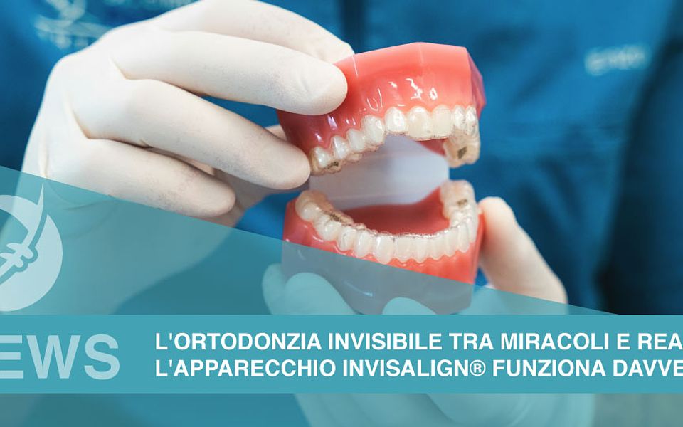 L’apparecchio Invisalign® funziona davvero? L’ortodonzia invisibile tra miracoli e realtà